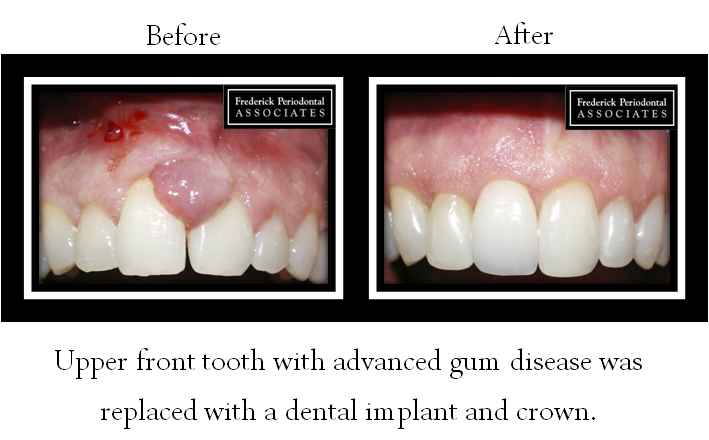 Before and after of dental implant and crown for advanced gum disease