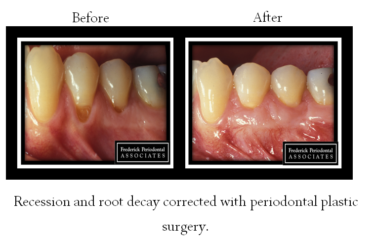 Before and after of periodontal surgery