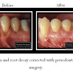 Before and after of periodontal surgery