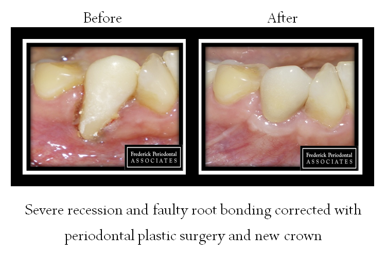 Before and after image of crown treatment