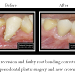 Before and after image of crown treatment