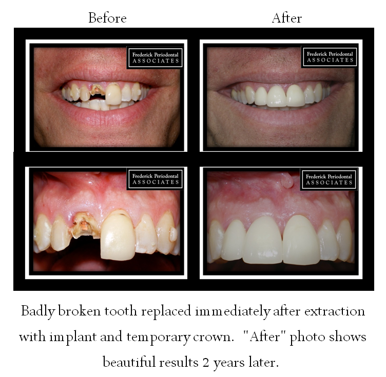 Before and after of tooth extraction with implant and temporary crown replacement