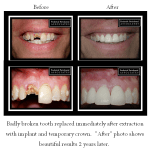 Before and after of tooth extraction with implant and temporary crown replacement