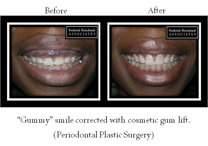 Before and after of gummy smile corrected with cosmetic gum lift