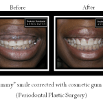 Before and after of gummy smile corrected with cosmetic gum lift
