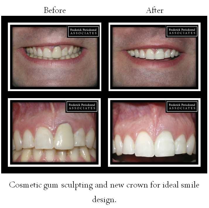Before and after of cosmetic gum sculpting with new crown
