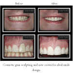 Before and after of cosmetic gum sculpting with new crown
