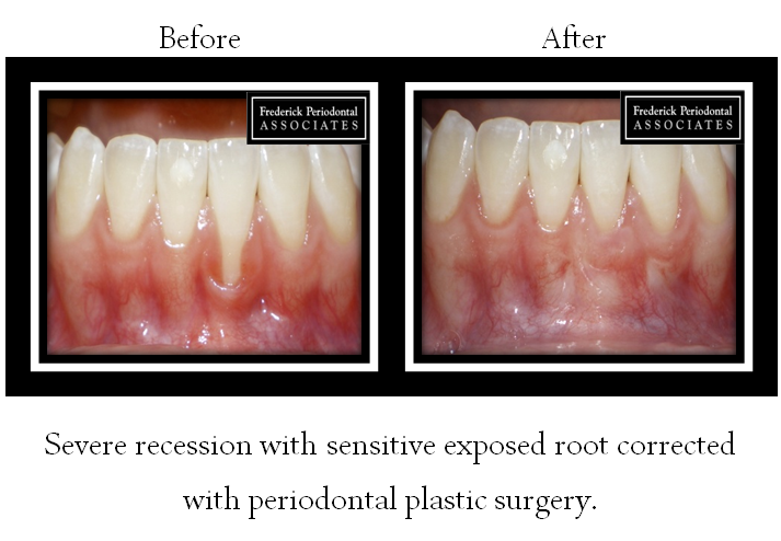Before and after for periodontal plastic surgery for severe gum recession