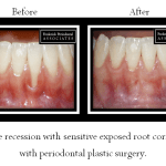 Before and after for periodontal plastic surgery for severe gum recession