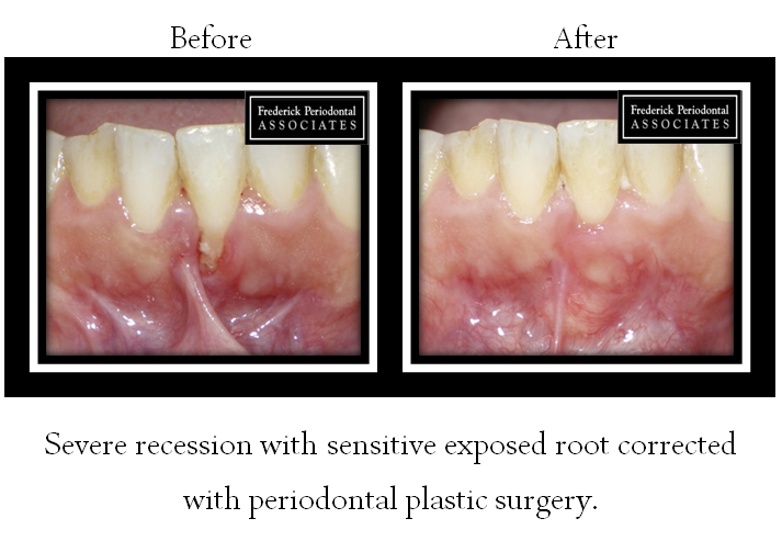 Before and after for periodontal plastic surgery for exposed root 