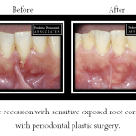 Before and after for periodontal plastic surgery for exposed root 