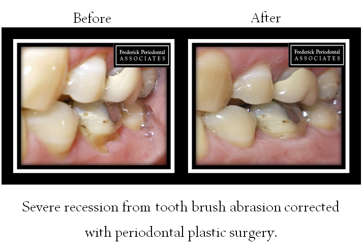 Before and after for periodontal plastic surgery from tooth brush abrasion