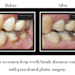 Before and after for periodontal plastic surgery from tooth brush abrasion