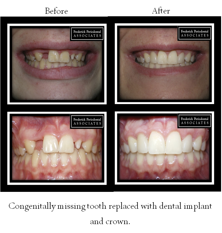 Before and after of dental implant and crown