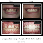 Before and after of dental implant and crown
