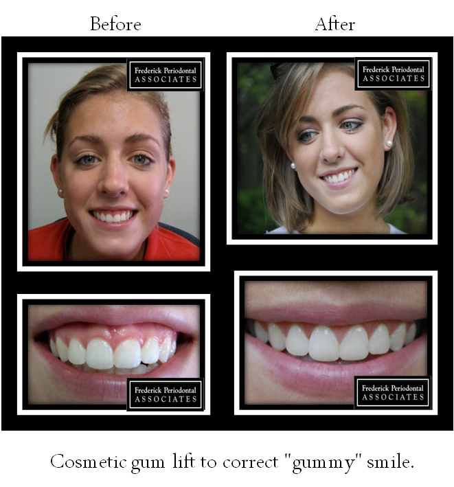 Before and after cosmetic gum lift