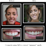Before and after cosmetic gum lift