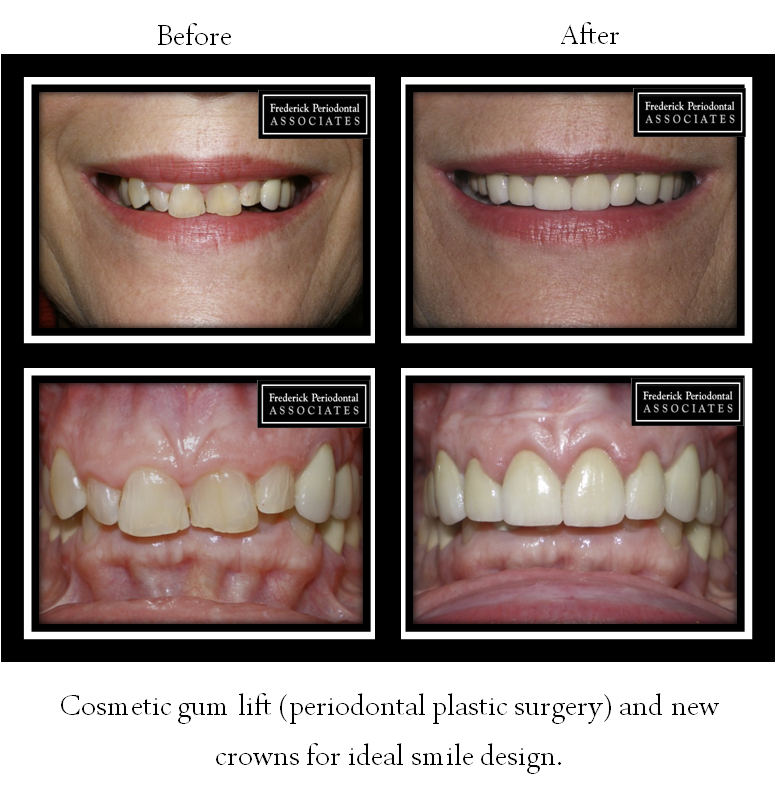 Before and after cosmetic gum lift with new crowns