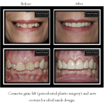 Before and after cosmetic gum lift with new crowns